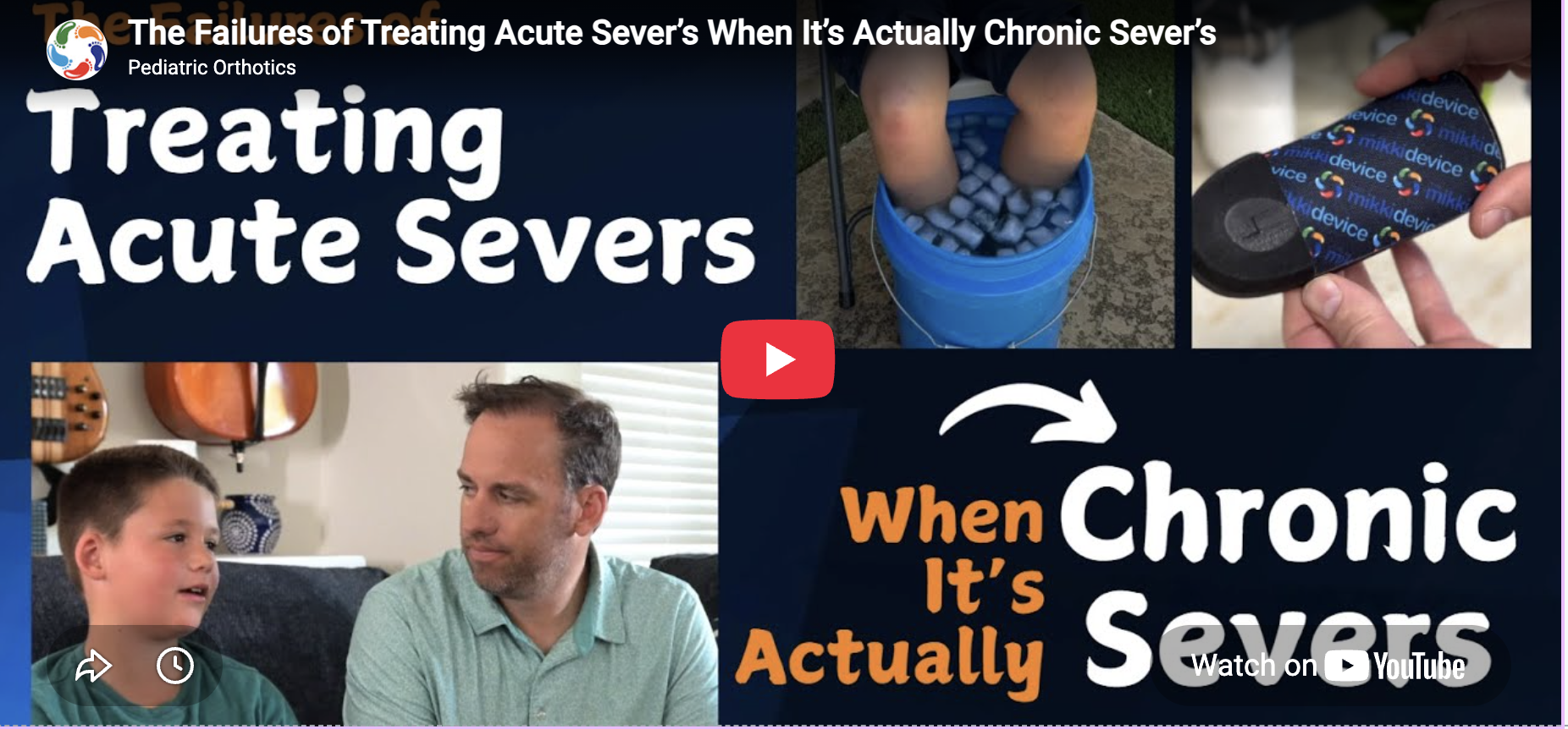 Treating Acute Sever's Disease