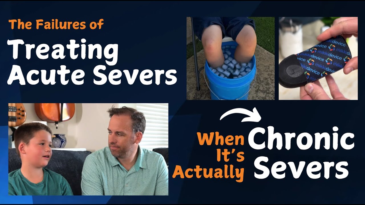 Treating Acute Severs